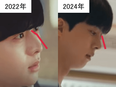 2022年（左）と2024年（右）のキム・ムジュンの鼻筋の比較