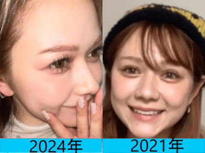 2024年（画像左）と2021年（画像右）で村重杏奈さんの鼻の頭の変化を比較している画像