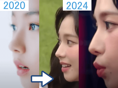 2020年（左）と2024年のカリナの鼻