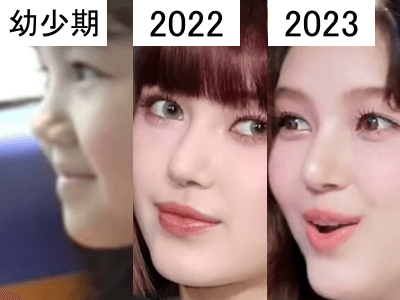 幼少期（左）、2022年（中）、2023年（右）のダニエルの鼻比較