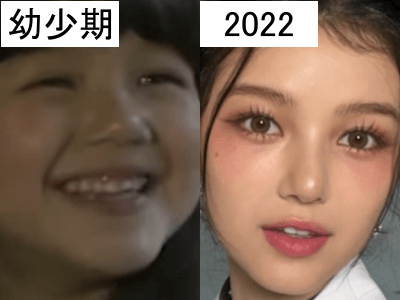 幼少期（左）と2022年（右）のダニエルの鼻比較