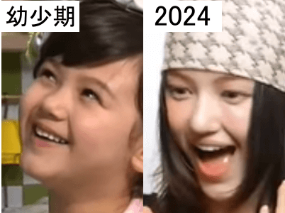 幼少期（左）と2024年（右）のダニエルの鼻比較