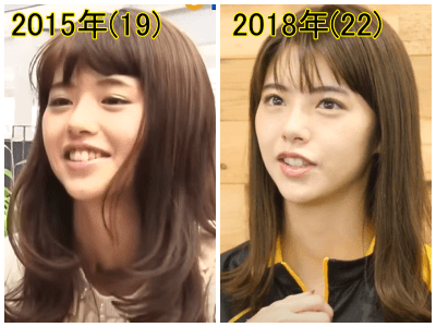 2015年（左）と2018年の鈴木ゆうかの口元比較