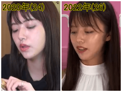 2020年（左）と2022年の鈴木ゆうかの口元比較