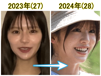 2023年（左）と2024年の鈴木ゆうかの口元比較